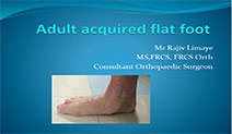Adult Acquired flat foot