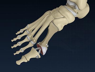 First toe MTP fusion surgery