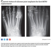 Current status of silicone joint implants for first MTPJ replacement